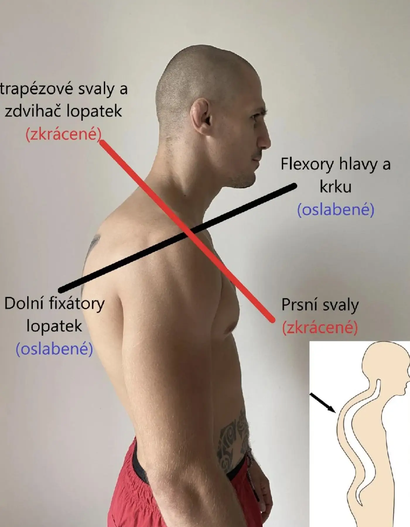 Horní zkřížený syndrom